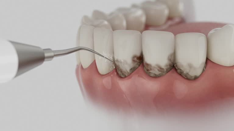Trusted Wisdom Tooth Removal service in Gaithersburg, MD - Dentist Open Now